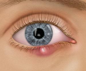 Clínica de Olhos Criciúma - 🔸Embora o terçol e o calázio sejam